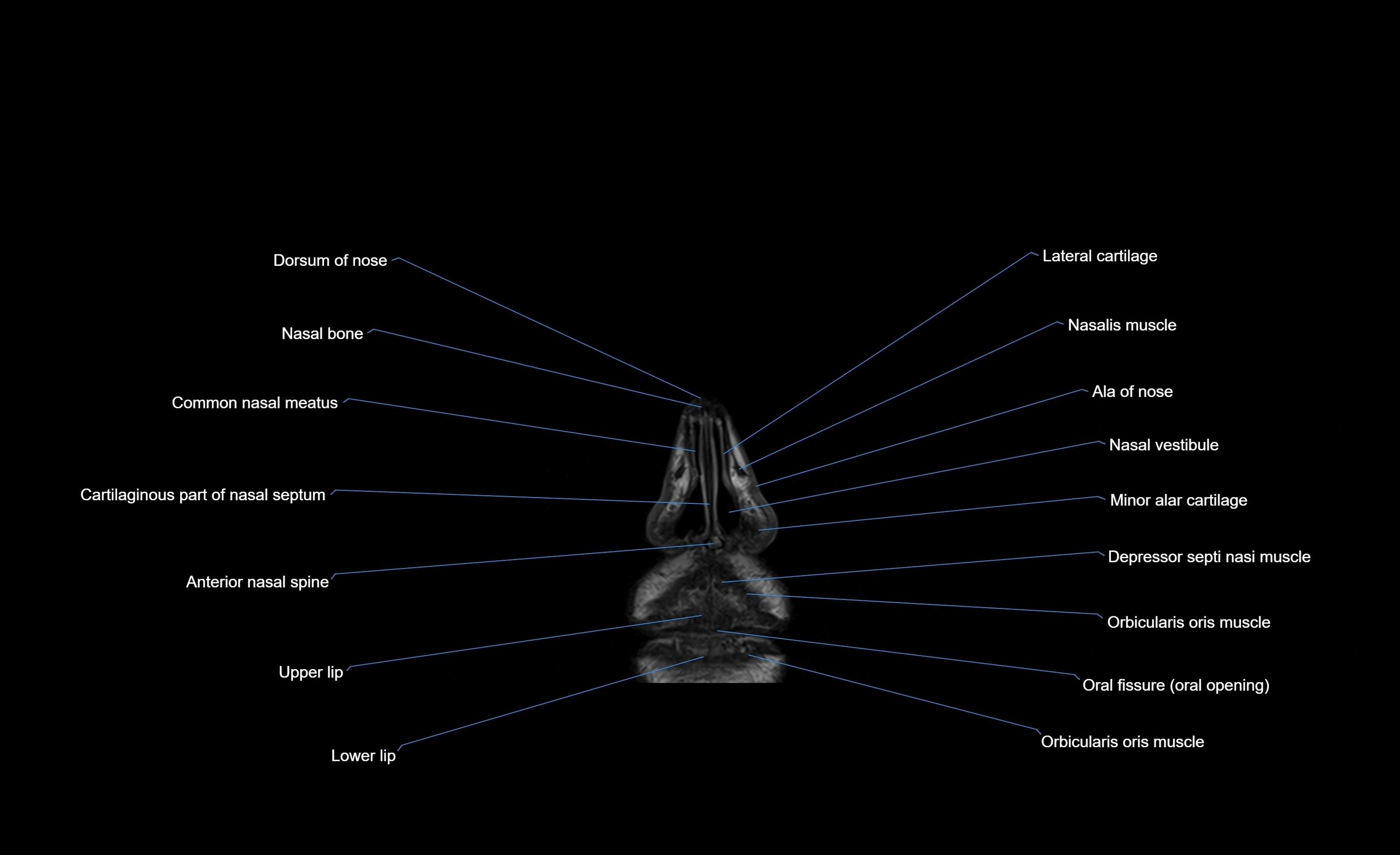 MRI face & paranasal sinuses(PNS) labelled  coronal  cross sectional anatomy 3T radiology  image-img-00001-00007.webp